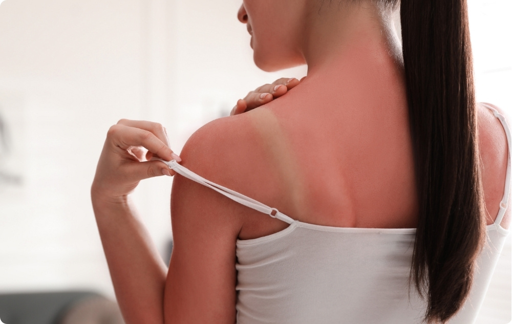 Jako olej po spálení sluncem